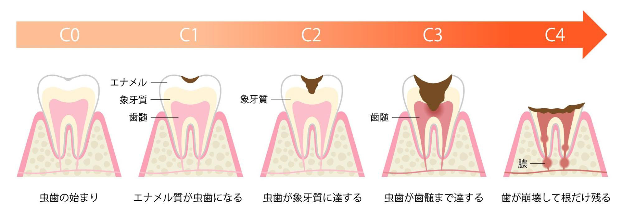 虫歯の進行度合いと主な治療法