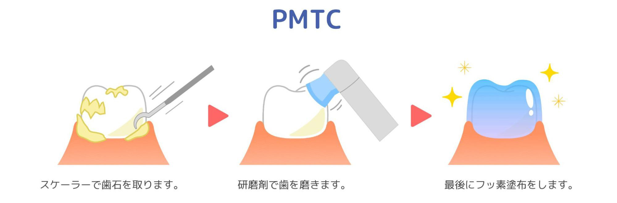 プロによるクリーニング（PMTC）
