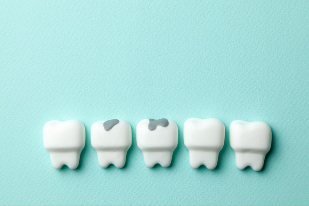 虫歯ができるメカニズム